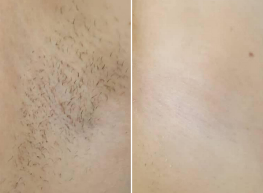Underarms