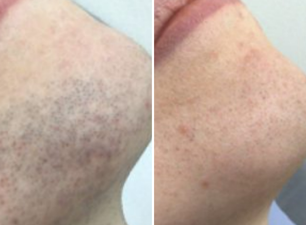 Laser-Hair-Removal facial