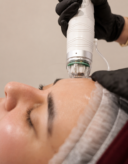 RF Microneedling