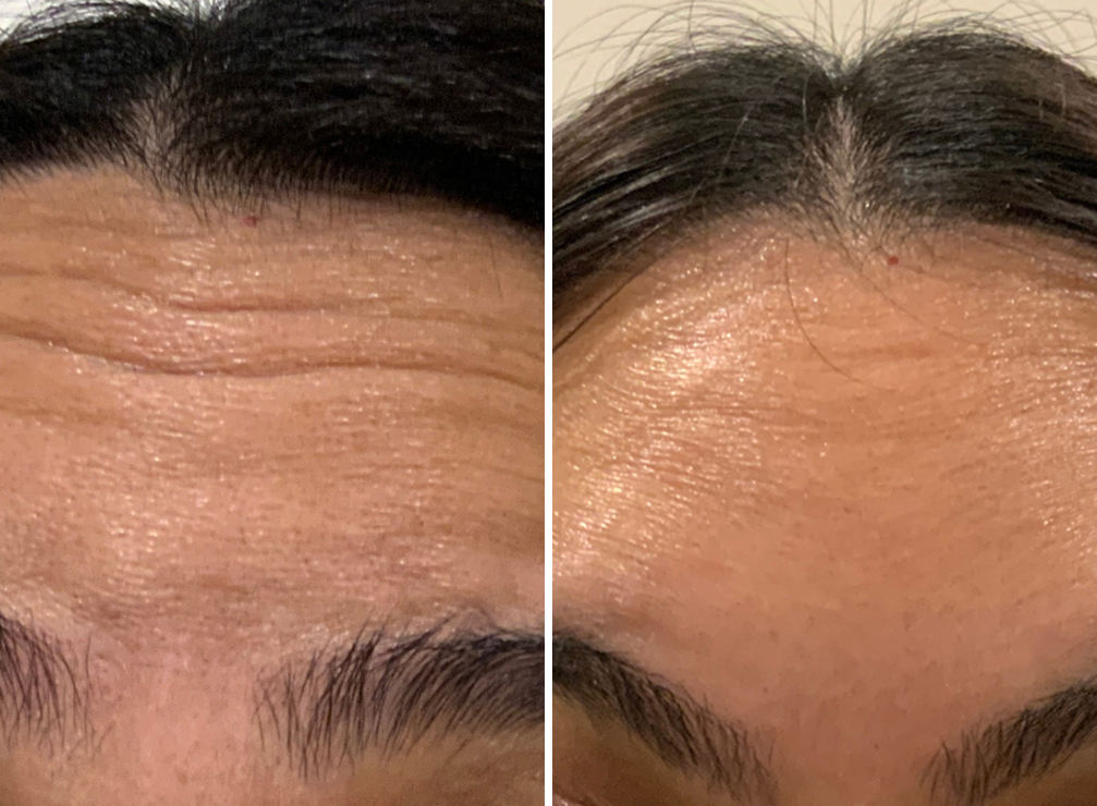 Forehead Lines