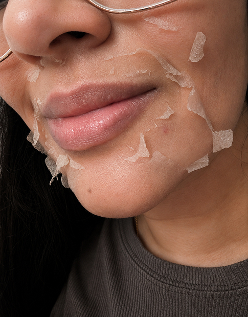 Chemical Peels