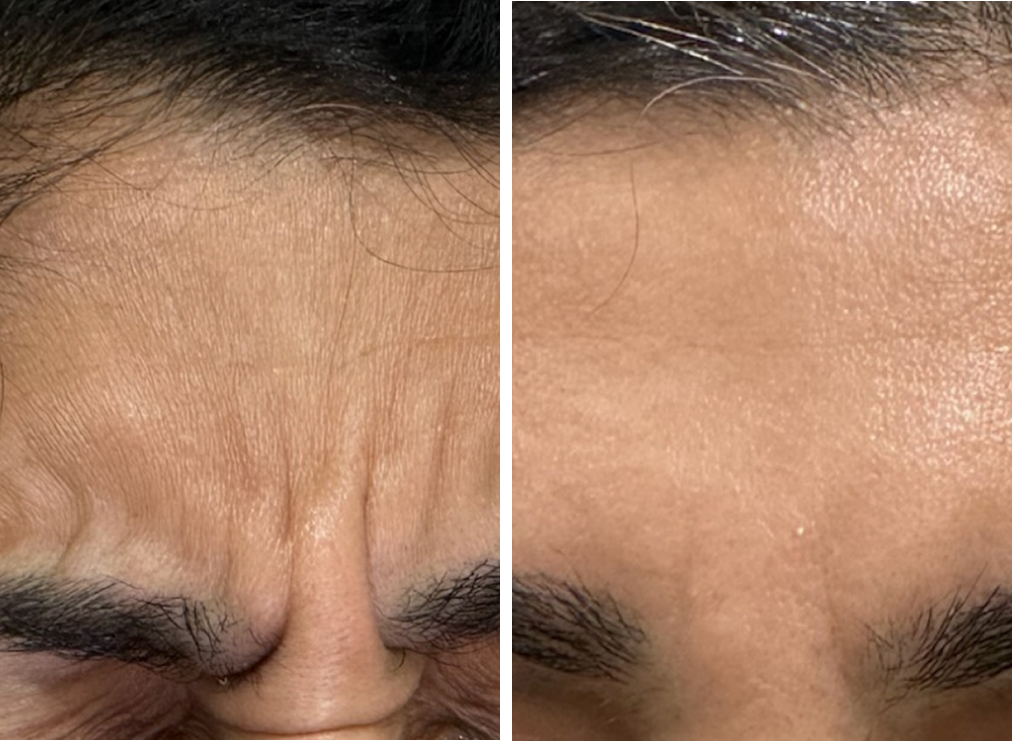 Forehead Lines
