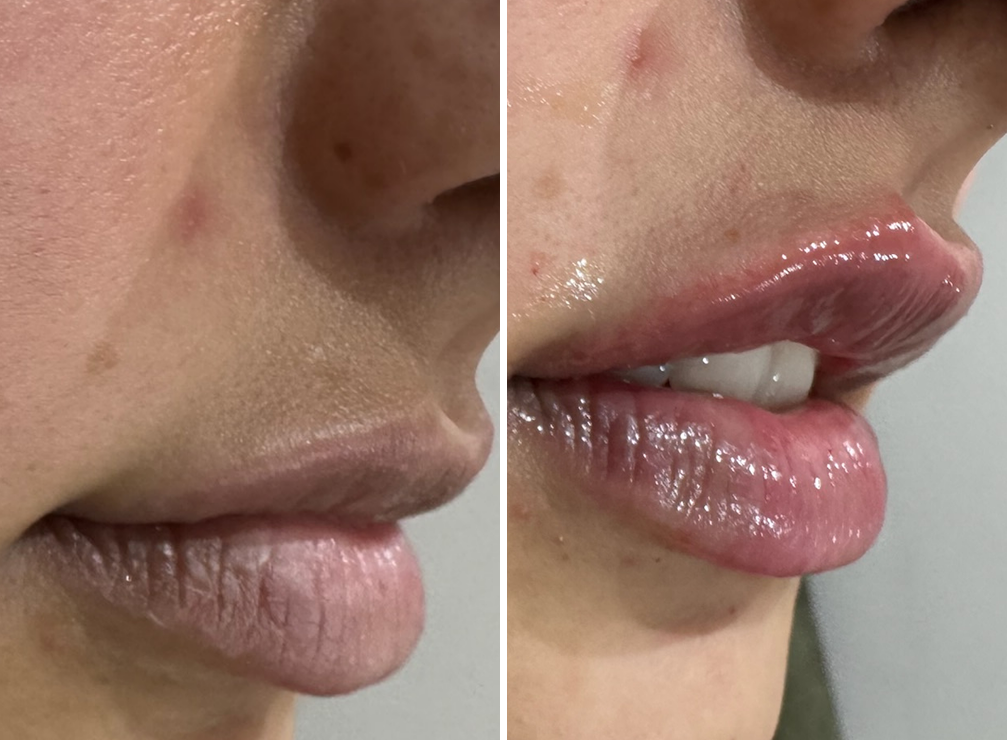Lip Rejuvenation