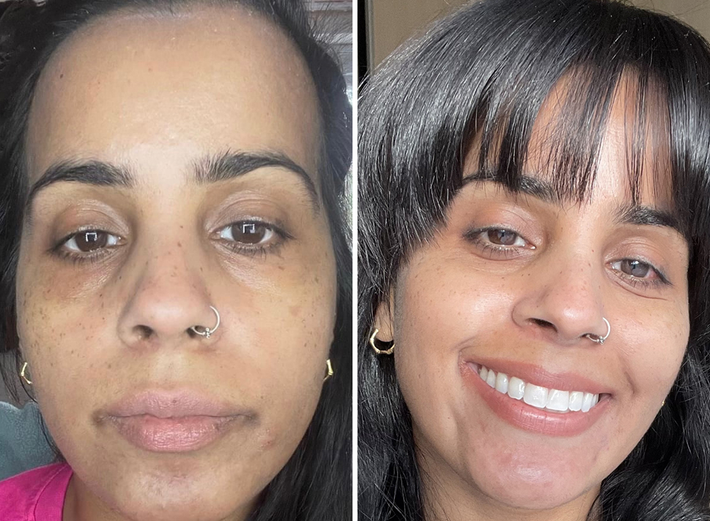 Lip Enhancement