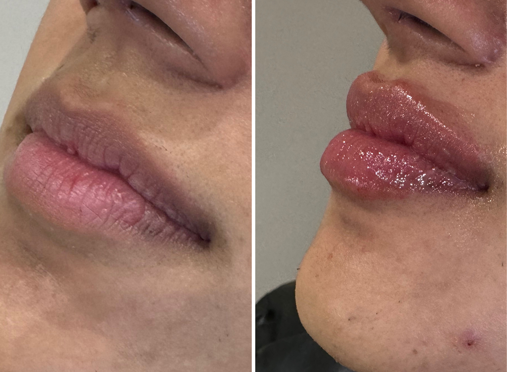 Lip Enhancement