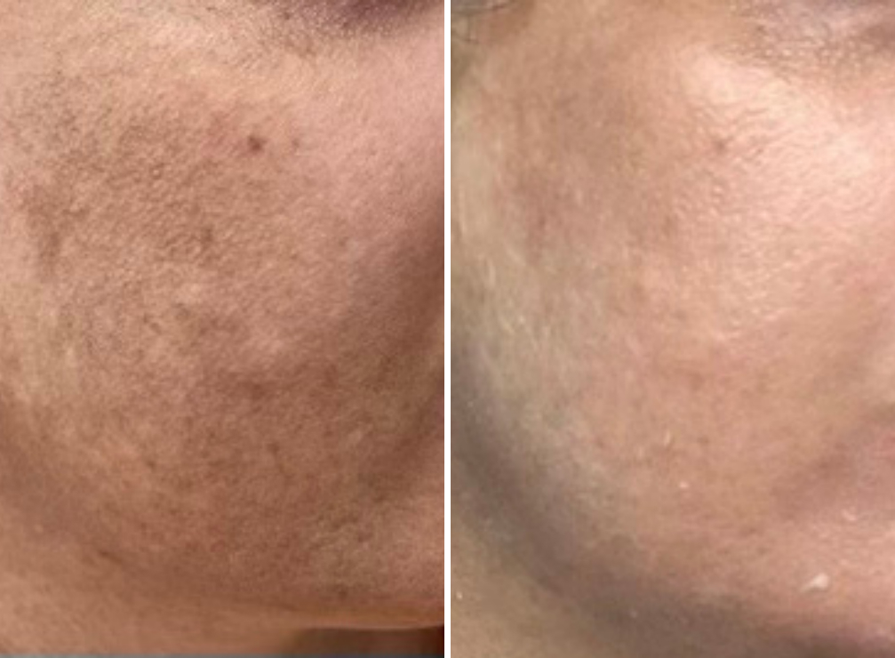 Enlarged Pores