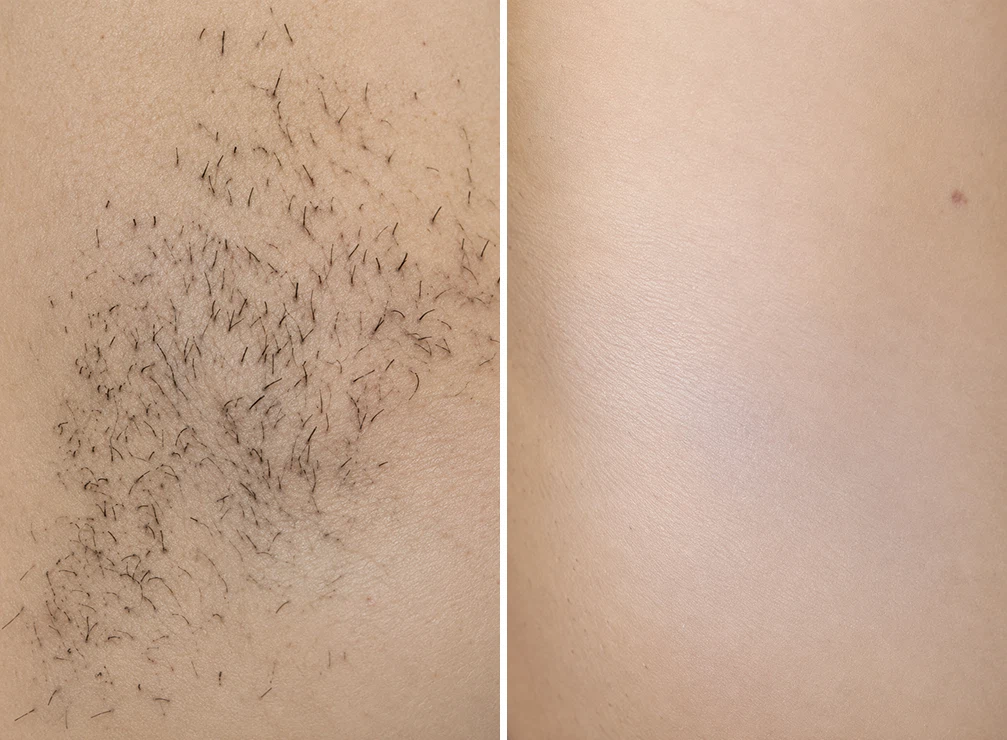 Laser Hair Removal