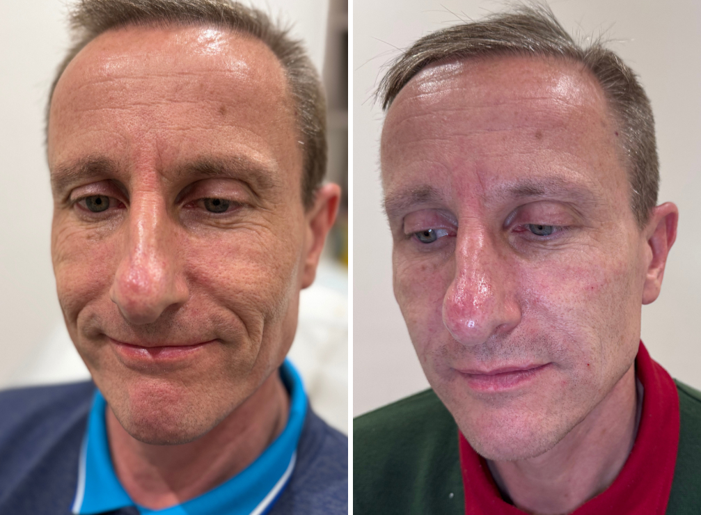 Facial rejuvenation
