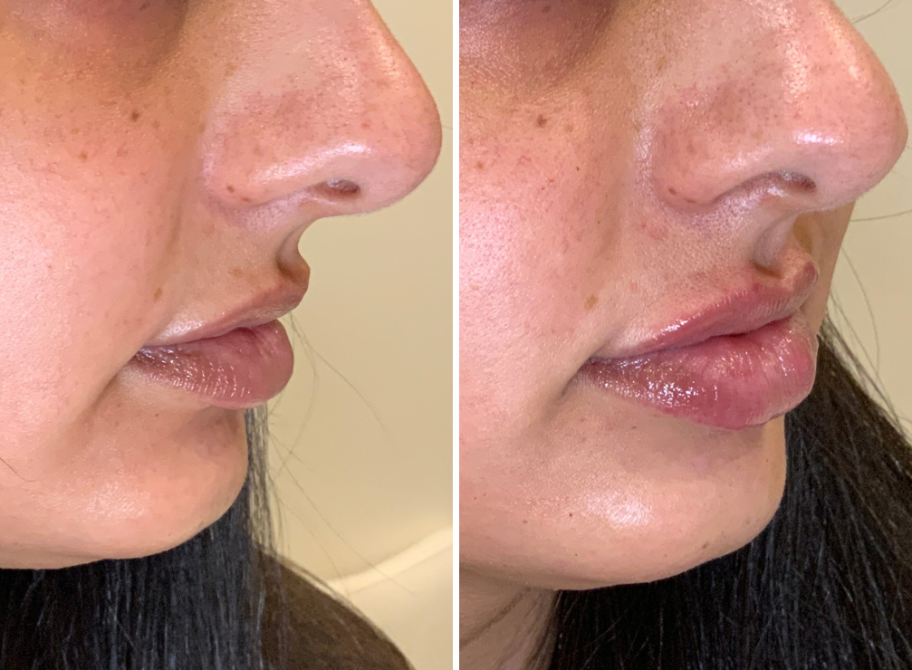 Lip Hydration