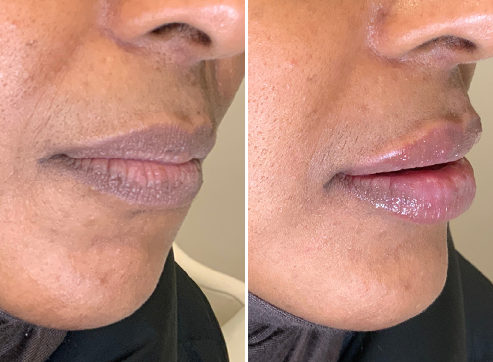 Lip Hydration