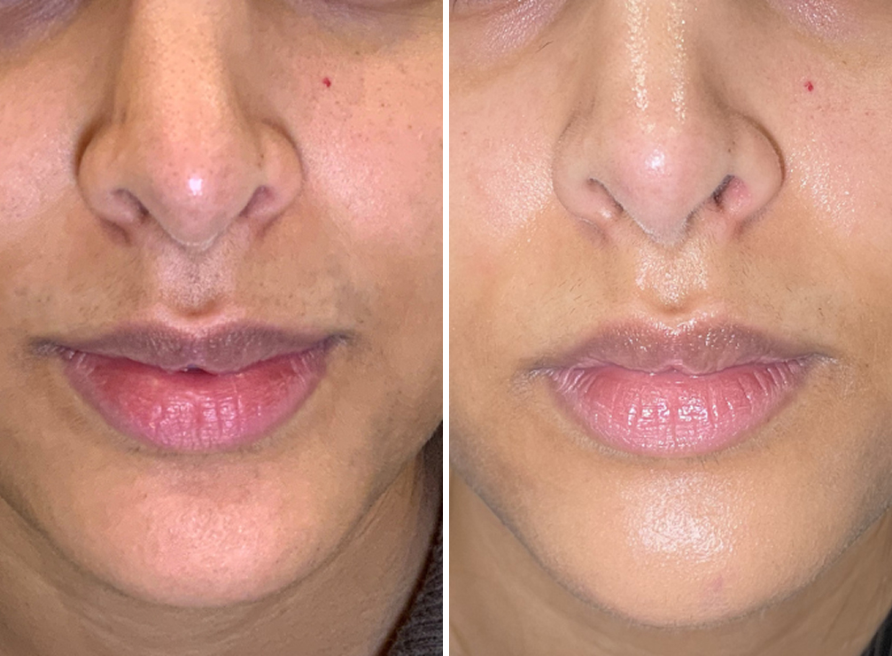 Skin Rejuvenation