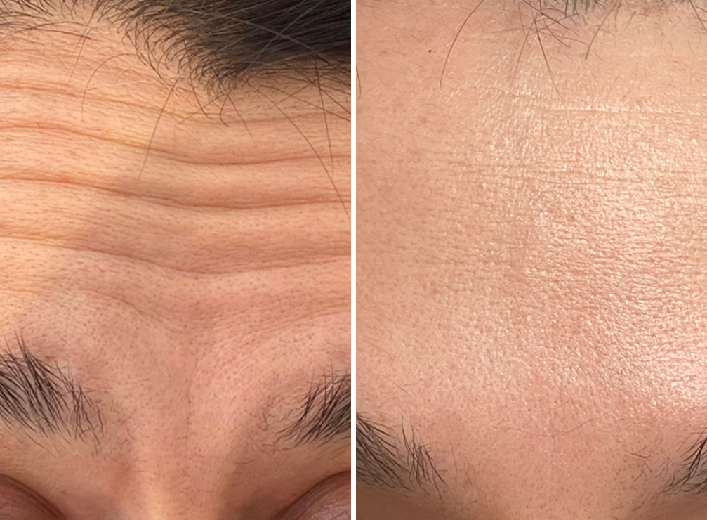Anti - Wrinkle Treatment
